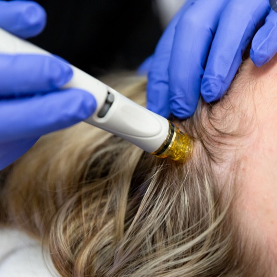 Hydrafacial Keravive | Hair Restoration Treatment